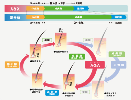 AGAのヘアサイクル